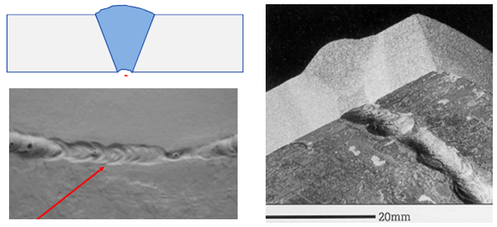 Root concavity Root concavity defect